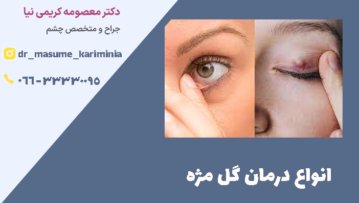 انواع درمان گل مژه
