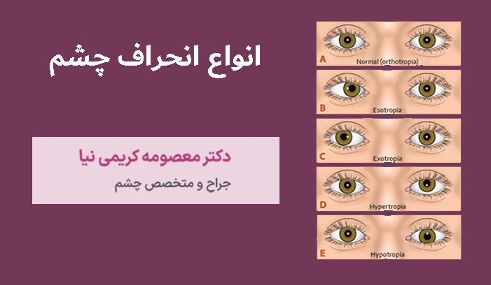 انواع انحراف چشم