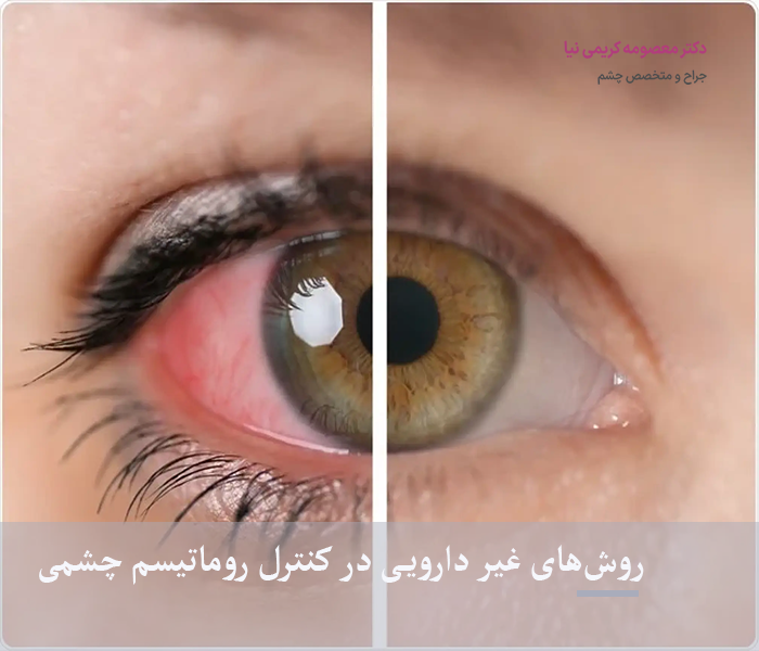 روش‌های غیر دارویی در کنترل روماتیسم چشمی