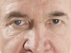 شخیص آب مروارید