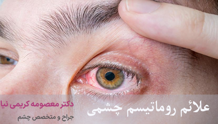 علائم روماتیسم چشمی