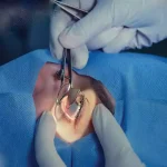 هزینه جراحی لیزیک چشم